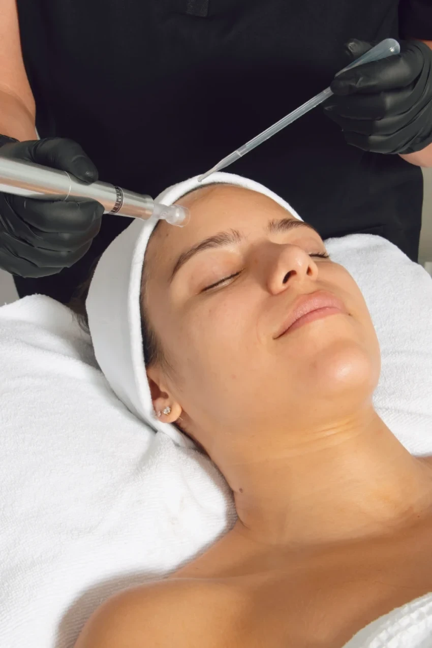 Microneedling-spa-facial-keila-domingues-skin-care