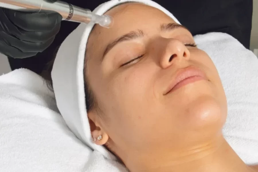 Microneedling-spa-facial-keila-domingues-skin-care